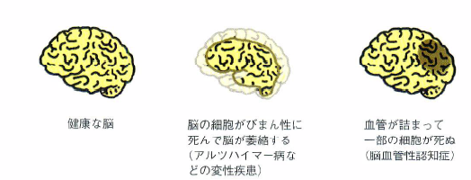 認知症（脳のイメージ）