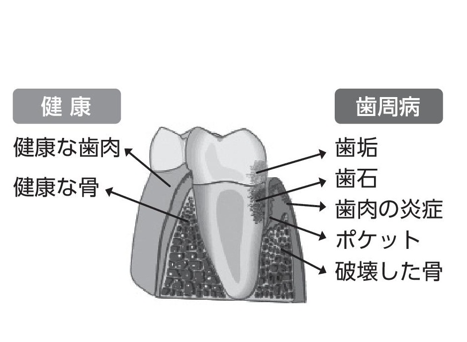 健康な歯と歯周病の歯