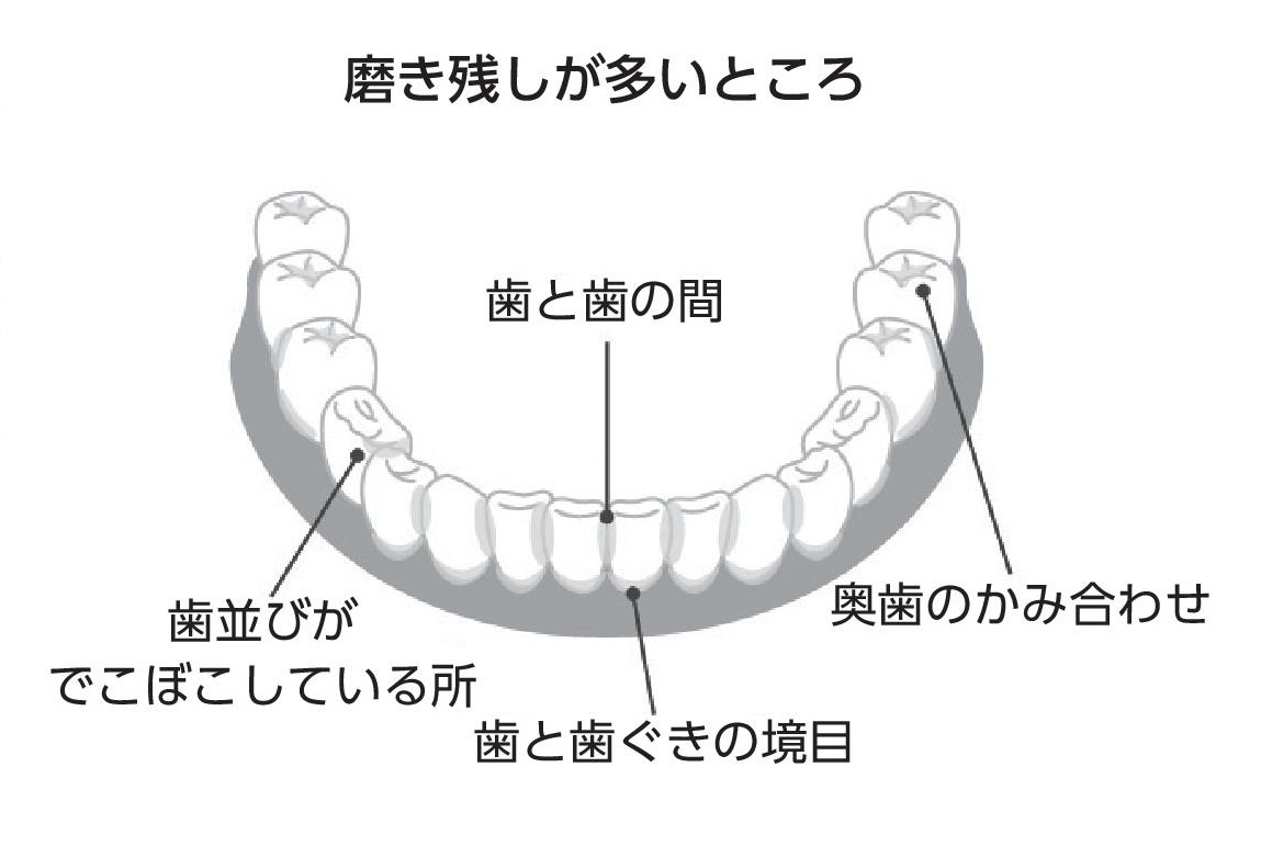 磨き残しが多いところ